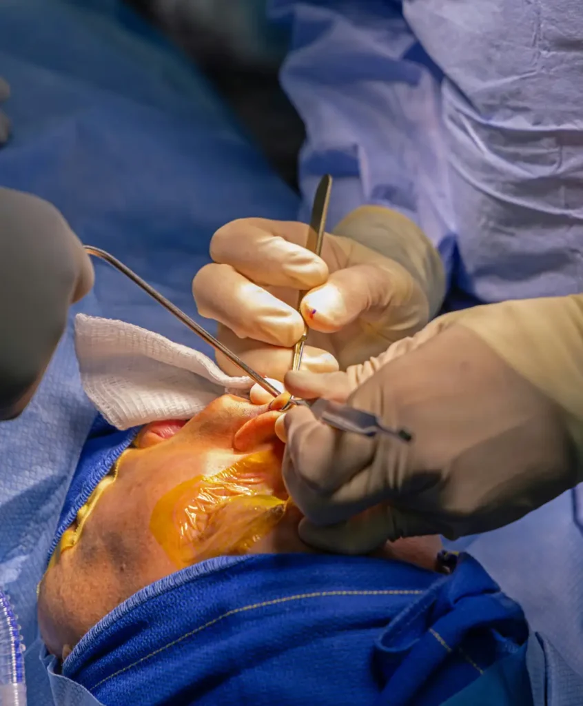 Revision rhinoplasty Surgical Procedure Portrayal